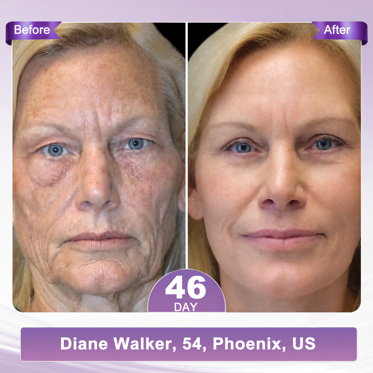1 FDA Official: 🎯𝐇𝐈𝐒𝐊𝐈𝐍® 𝐏𝐃𝐑𝐍 𝐌𝐮𝐥𝐭𝐢-𝐏𝐞𝐩𝐭𝐢𝐝𝐞 𝐌𝐚𝐬𝐬𝐚𝐠𝐢𝐧𝐠 𝐁𝐨𝐝𝐲 𝐑𝐨𝐥𝐥𝐞𝐫 𝐂𝐫𝐞𝐚𝐦- Anti-aging, Hydrating, Skin Firming & Lifting, Skin Repair, Even Tone, Acne and Dark Spot Treatment, Wart and Mole Removal, and Psoriasis Relief.